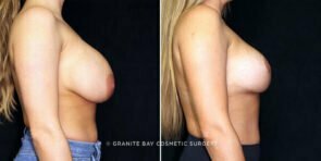 breast-implant-exchange-lift-decrease-3572c-gbc