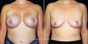 breast-implant-removal-25149a-gbc