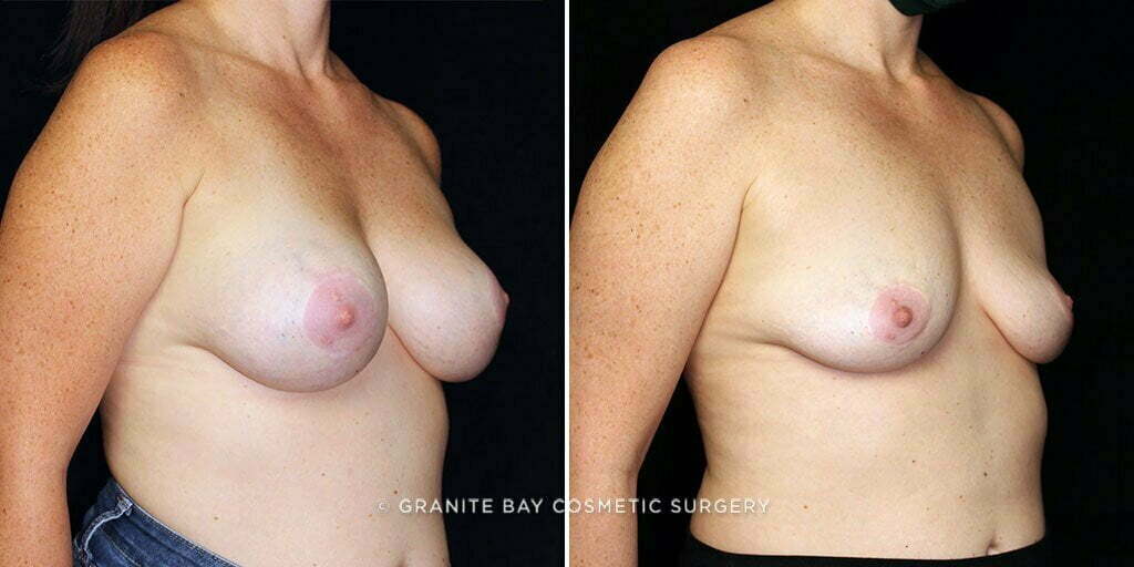 breast-implant-removal-25149b-gbc