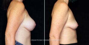 breast-implant-removal-25149c-gbc