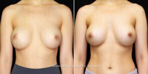 breast-revision-22041a-gbc