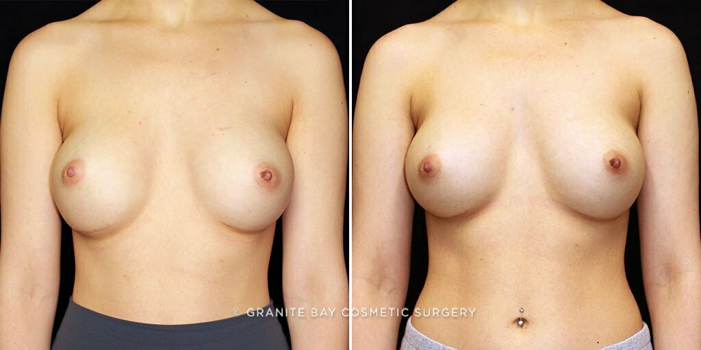 Breast Revision Implant Exchange