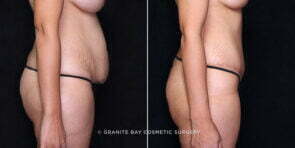 tummy-tuck-liposuction-19938c-gbc
