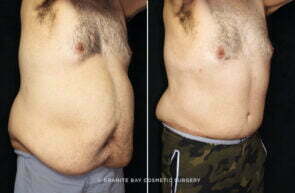 abdominoplasty-body-lift-liposuction-25864b-gbc