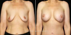 breast-lift-implants-25737a-gbc