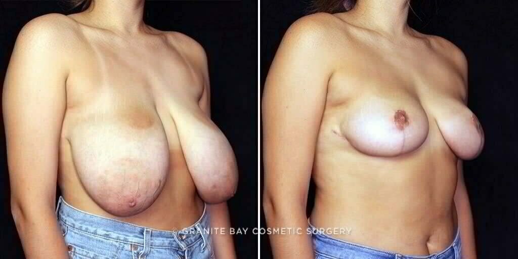 breast-reduction-26031-b-gbc