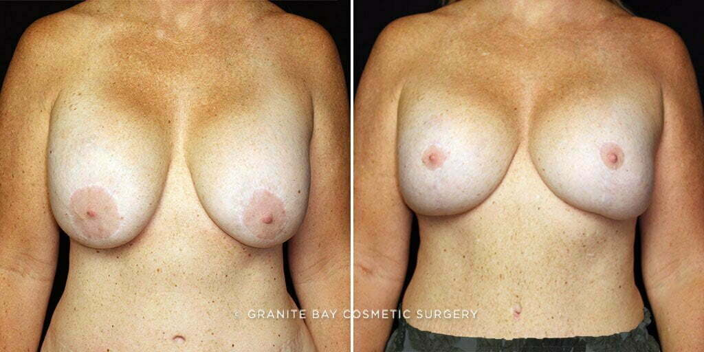 Breast Revision Implant Exchange