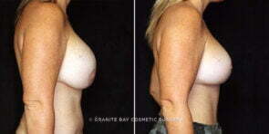 mmo-breast-implant-exchange-23641c-gbc