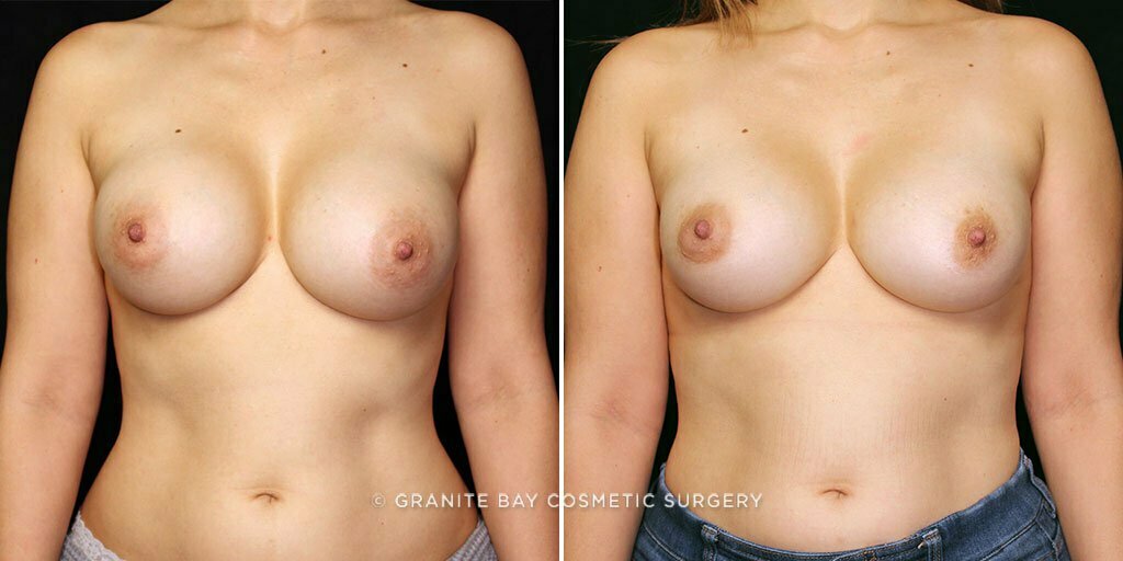 Breast Revision Implant Exchange