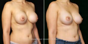 breast-implant-exchange-25233b-gbc