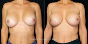 breast-implant-exchange-26056a-gbc
