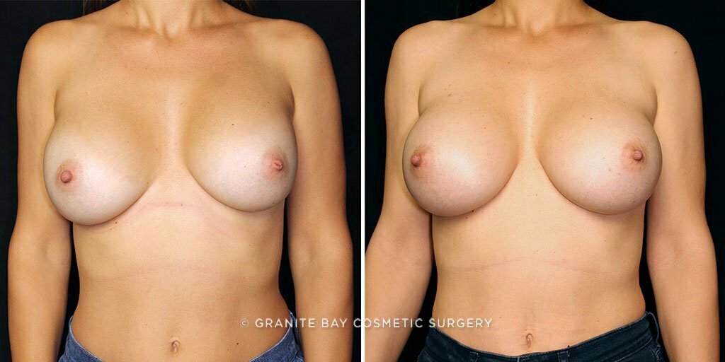 Breast Revision Implant Exchange
