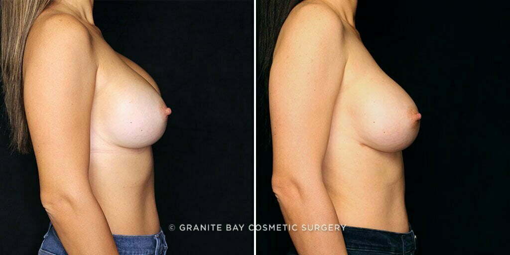 breast-implant-exchange-26056c-gbc