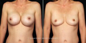 breast-implant-removal-25945a-gbc