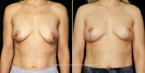 breast-lift-implant-rempoval-24751a-gbc