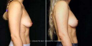 breast-lift-implant-rempoval-24751c-gbc