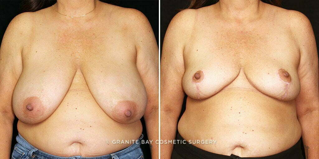 breast-reduction-26318a-gbc