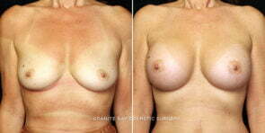 breast-augmentation-22029a-gbc