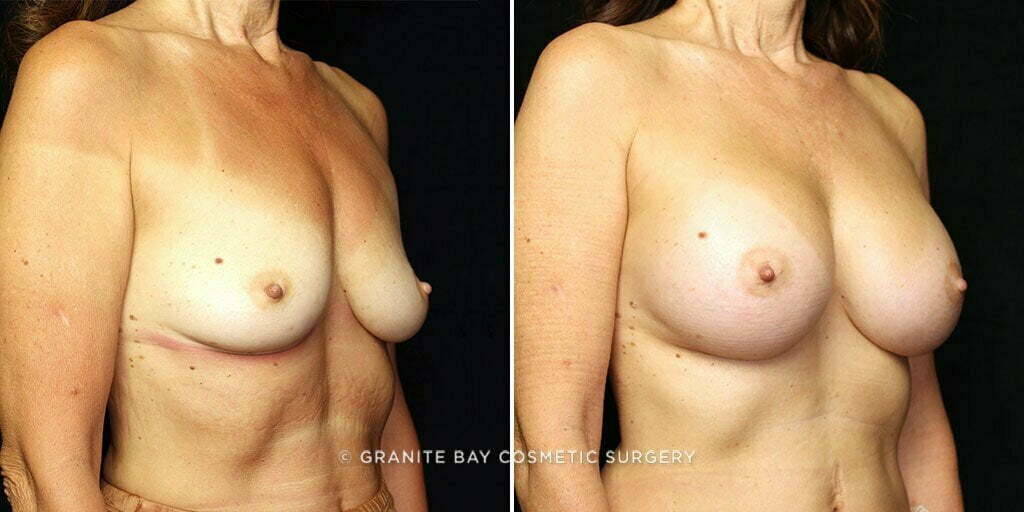 breast-augmentation-22029b-gbc