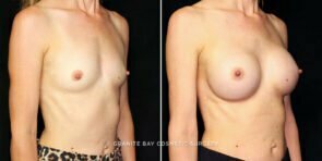 breast-augmentation-24855b-gbc