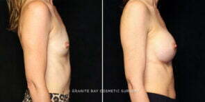 breast-augmentation-24855c-gbc