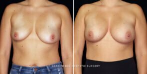 breast-augmentation-25373a-gbc
