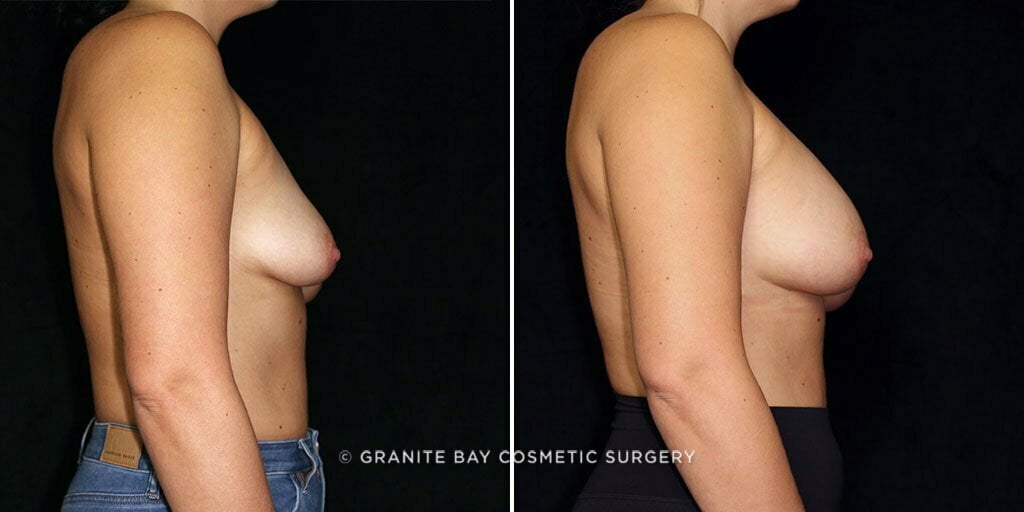 breast-augmentation-25373c-gbc