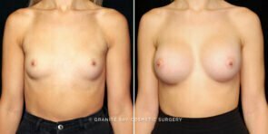 breast-augmentation-25570a-gbc