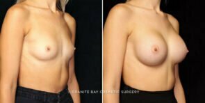 breast-augmentation-25570b-gbc