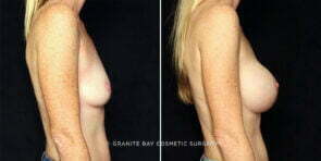 breast-augmentation-26336c-gbc
