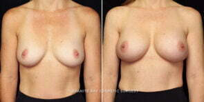 breast-augmentation-26551a-gbc