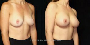breast-augmentation-26551b-gbc