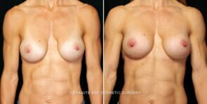 breast-implant-exchange-26168a-gbc
