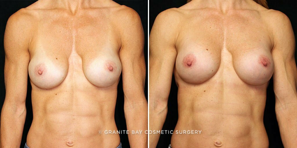 Breast Revision Implant Exchange