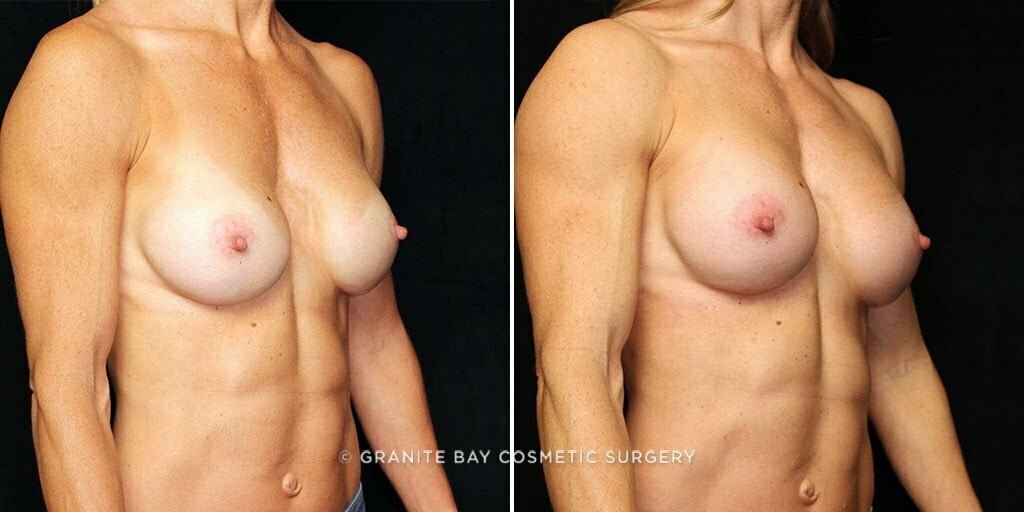breast-implant-exchange-26168b-gbc