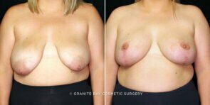 breast-implant-exchange-with-lift-26233a-gbc