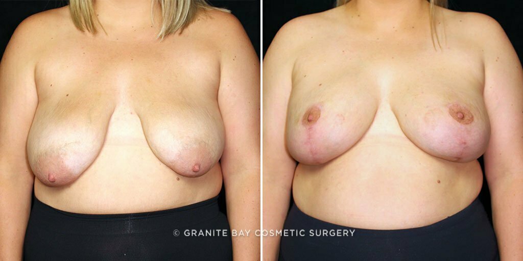 Breast Revision Implant Exchange with Lift