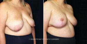 breast-implant-exchange-with-lift-26233b-gbc