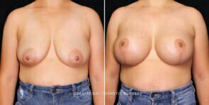 breast-lift-implants-26387a-gbc