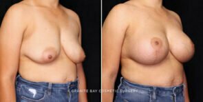 breast-lift-implants-26387b-gbc