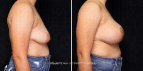 breast-lift-implants-26387c-gbc