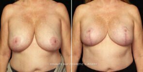 breast-lift-with-implants-25293a-gbc