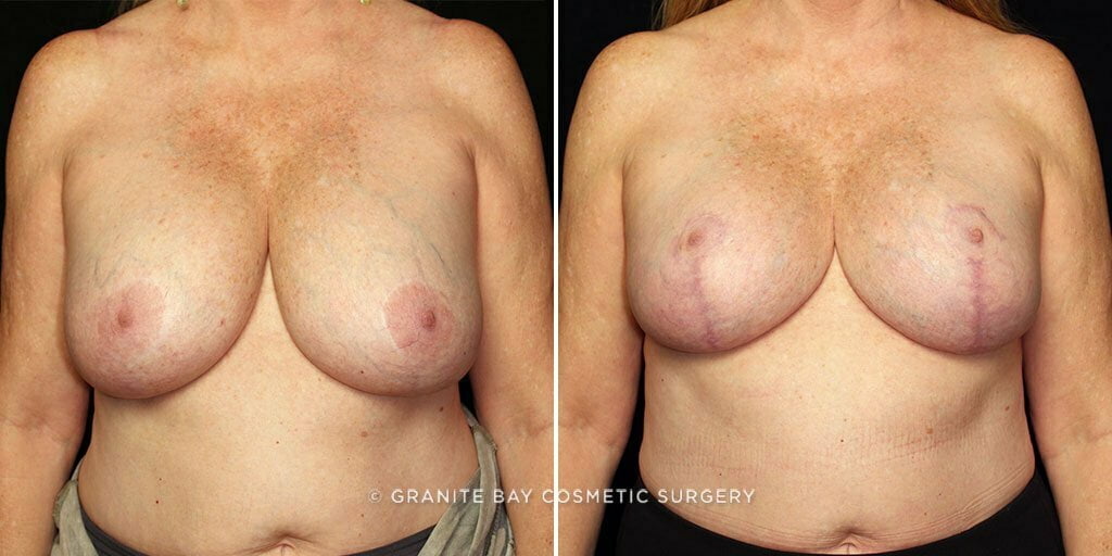 breast-lift-with-implants-25293a-gbc