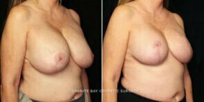 breast-lift-with-implants-25293b-gbc