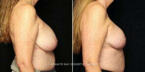 breast-lift-with-implants-25293c-gbc
