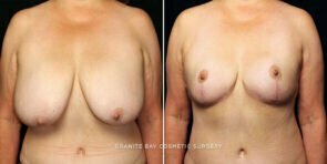 breast-reduction-23548a-gbc
