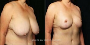 breast-reduction-23548b-gbc