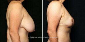 breast-reduction-23548c-gbc