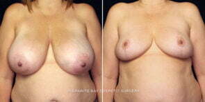 breast-reduction-25674a-gbc