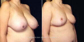 breast-reduction-25674b-gbc